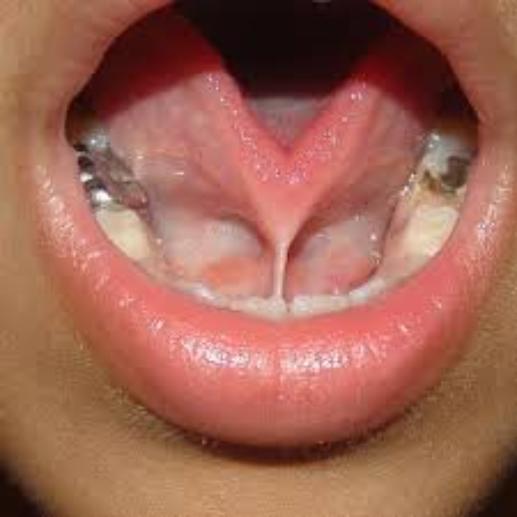 Fraenectomy / Tongue-Tie Release Explanation & Warnings5