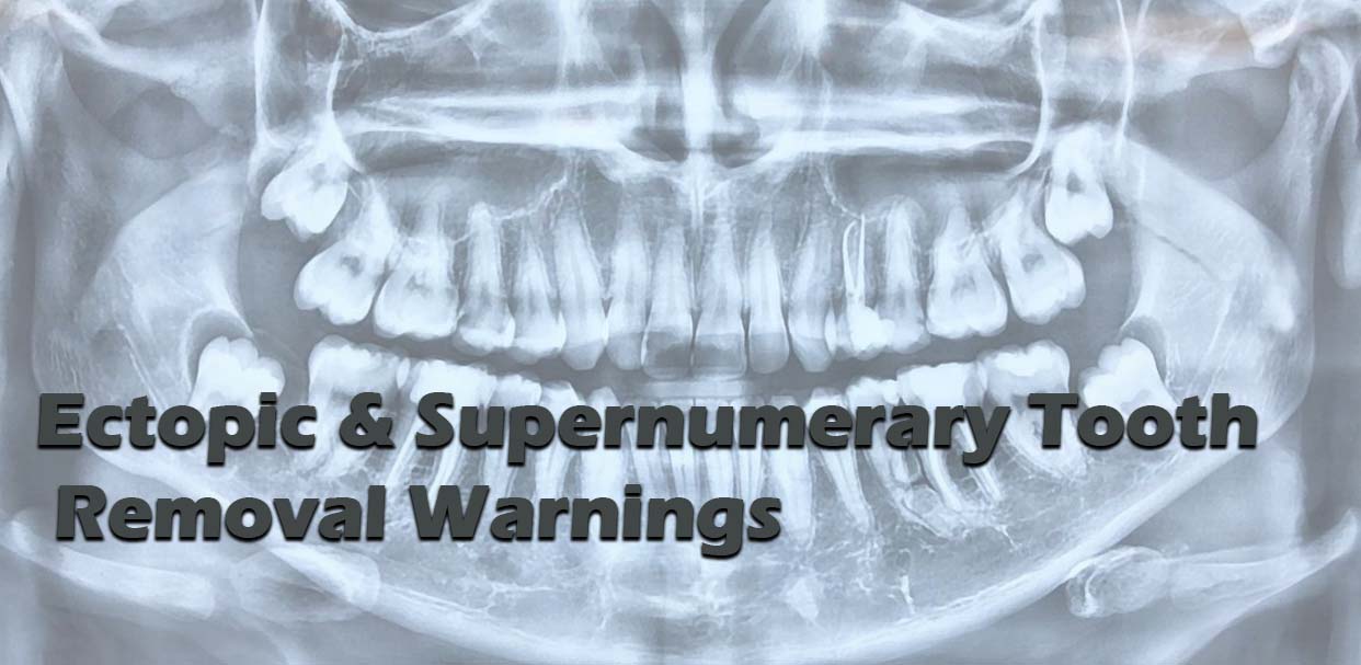 Ectopic & Supernumerary Tooth Removal Warnings