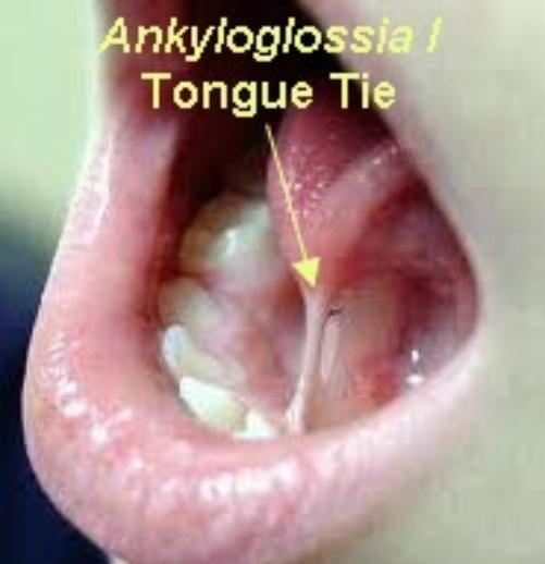 Fraenectomy / Tongue-Tie Release Explanation & Warnings10