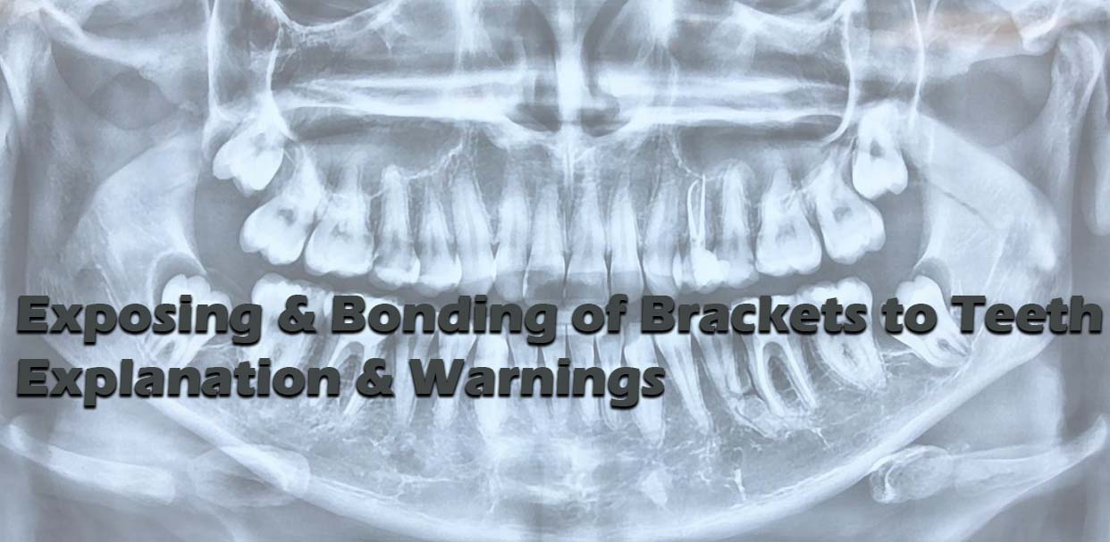 Exposing & Bonding of Brackets to Teeth Explanation & Warnings