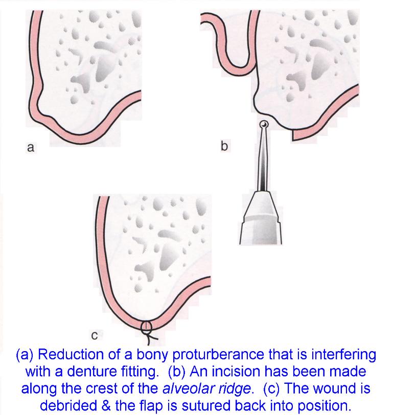 Alveoplasty (Alveoloplasty)0