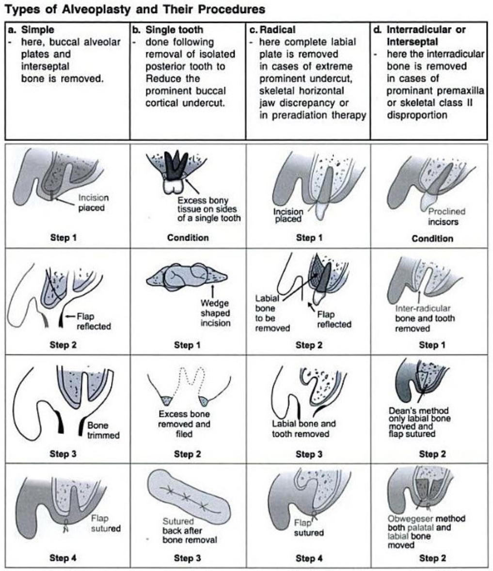 Alveoplasty (Alveoloplasty)0