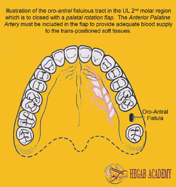 Closure of a Mouth-Sinus Communication with a Palatal Rotation Flap1