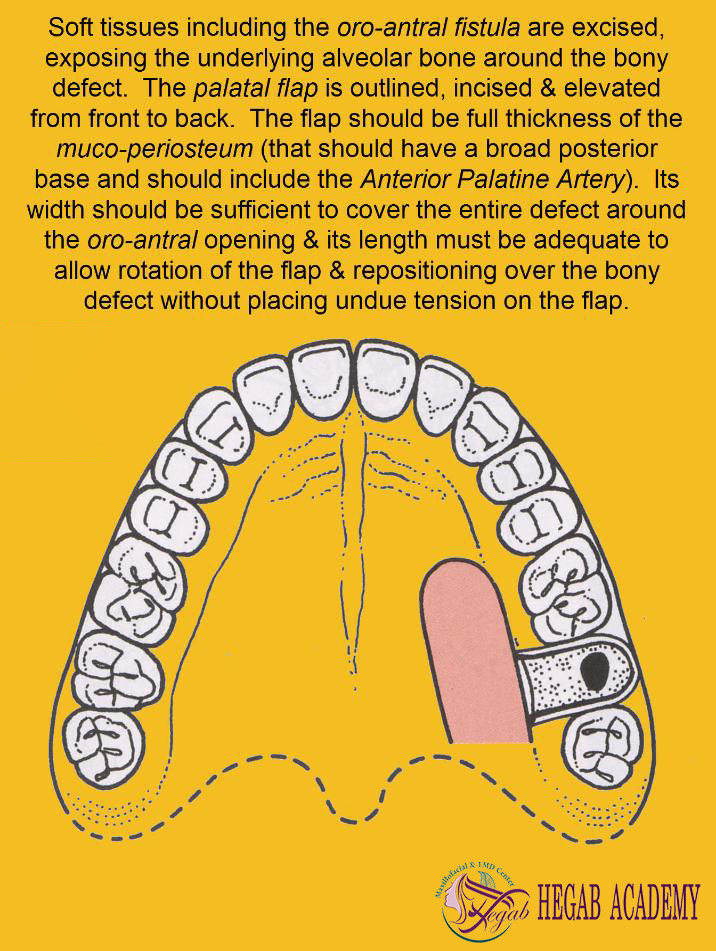 Closure of a Mouth-Sinus Communication with a Palatal Rotation Flap2