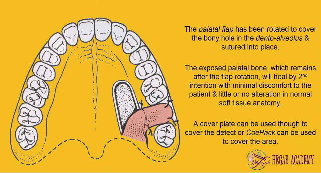 Closure of a Mouth-Sinus Communication with a Palatal Rotation Flap3