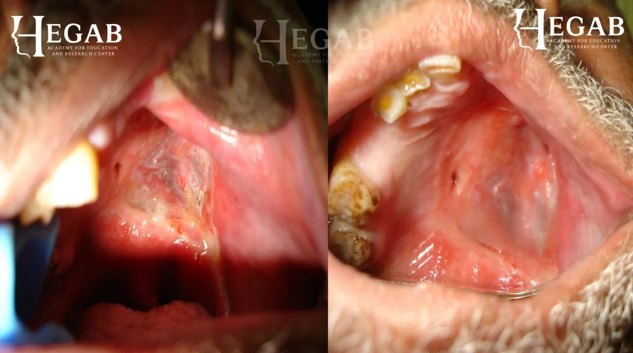 Surgical Removal of SCC from Maxillary Tuberosity with Skin Grafting Via Weber Fergusson Approach
