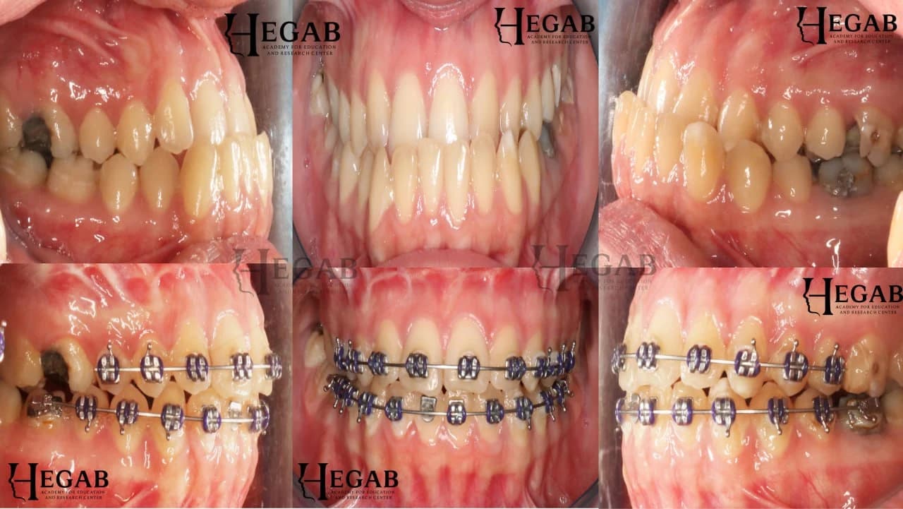 Correction of Midface Deficiency with Le-fort 1 And Orthodontic Treatment
