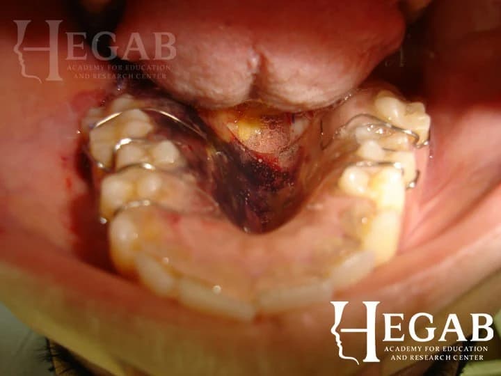Surgical Removal of Pleomorphic Adenoma from The Palatal Mucosa with Buccal Bad Fat Graft