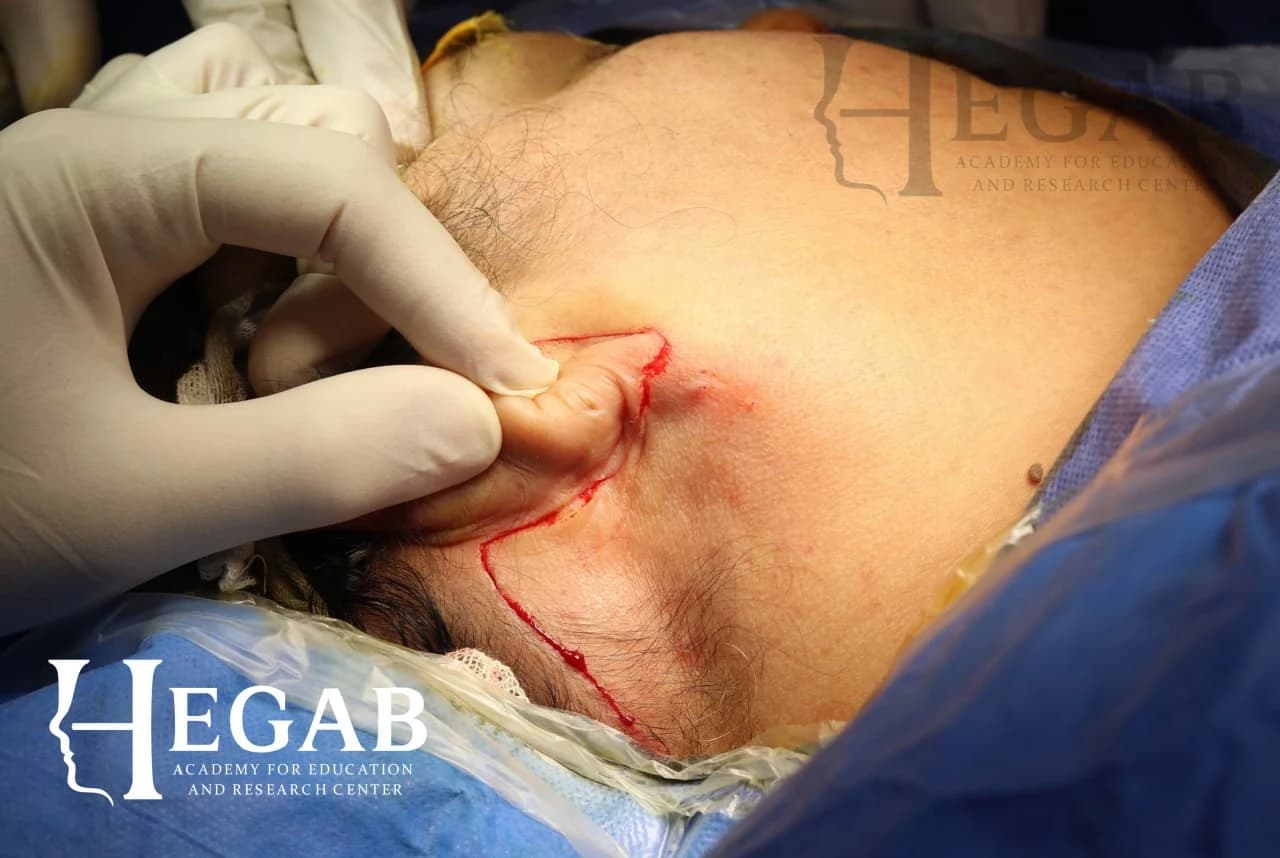 Surgical Removal of Pleomorphic Adenoma from deep Lobe of Parotid Gland with gland preservation and without facial nerve injury