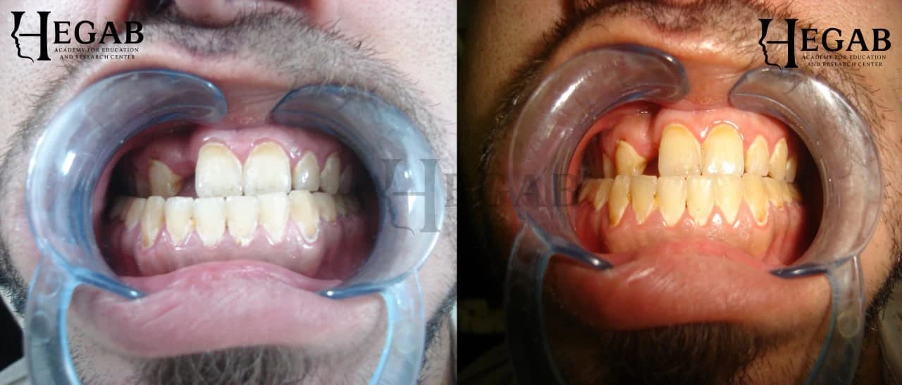 Segmental Le-Fort 1 Osteotomy for Post-Traumatic Midface Deficiency
