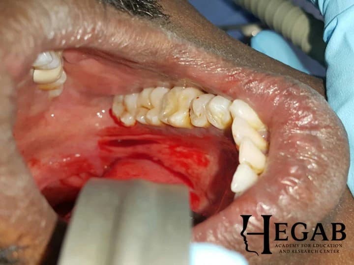 Intraoral Removal of Submandibular Gland Stone Deeper Near the Gland
