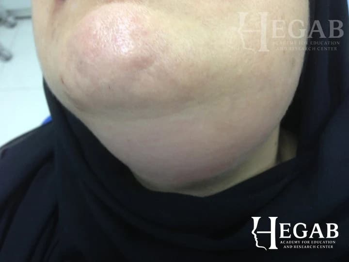 Intraoral Removal of Submandibular Gland Stone Deeper Near the Gland