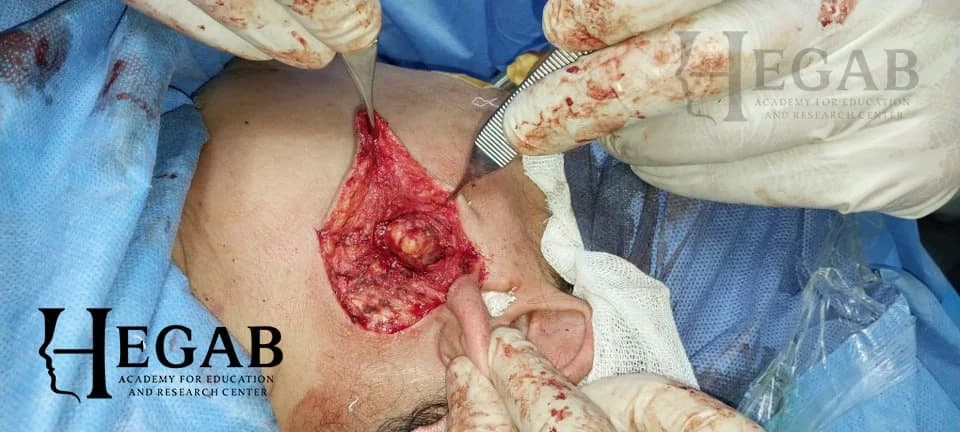 Surgical Removal of Pleomorphic Adenoma from Superficial Lobe of Parotid Gland with gland preservation and without facial nerve injury