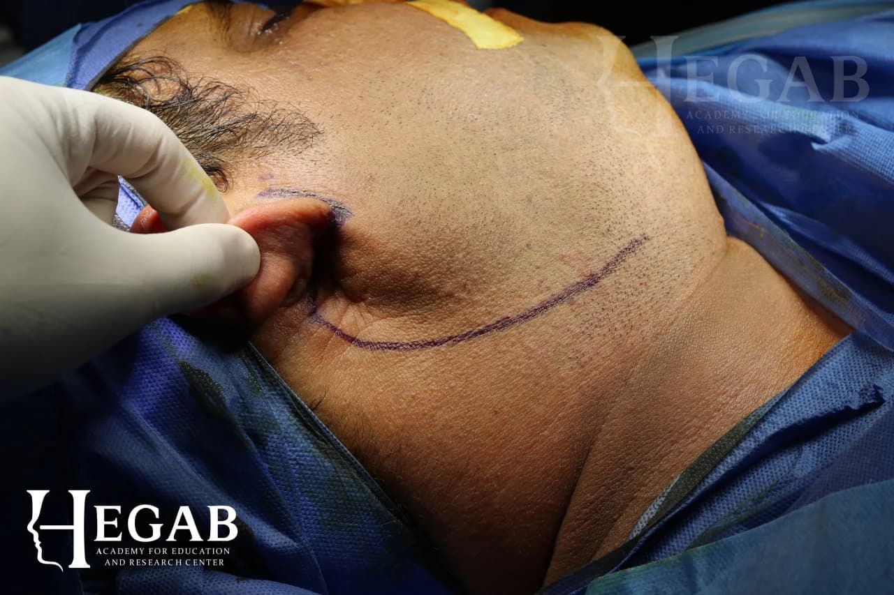Surgical Removal of Pleomorphic Adenoma from Superficial Lobe of Parotid Gland with gland preservation and without facial nerve injury