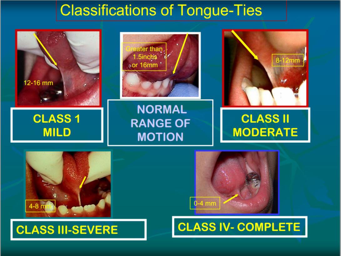 Fraenectomy / Tongue-Tie Release Explanation & Warnings11