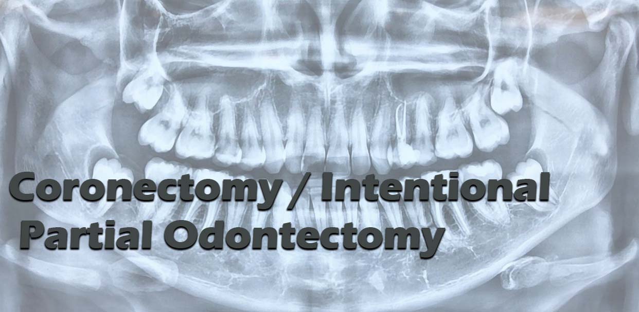 Coronectomy / Intentional Partial Odontectomy