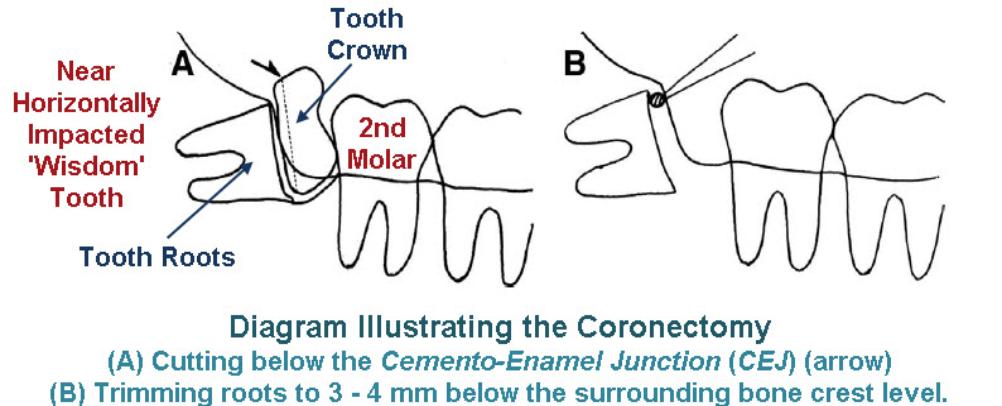 Coronectomy / Intentional Partial Odontectomy18