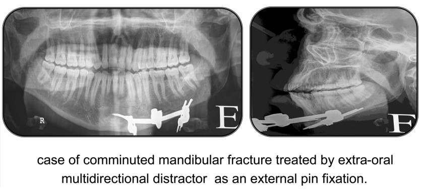 Extra-oral MultiDirectional Distractor: A Multi Uses Distractor8