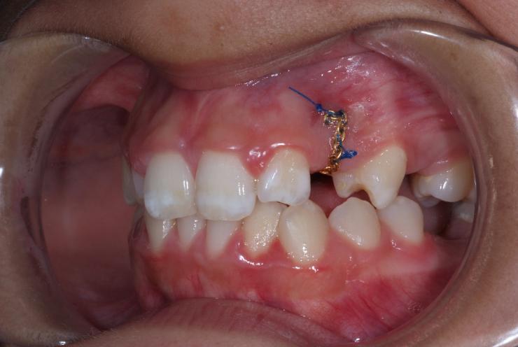 Exposing & Bonding of Brackets to Teeth Explanation & Warnings6