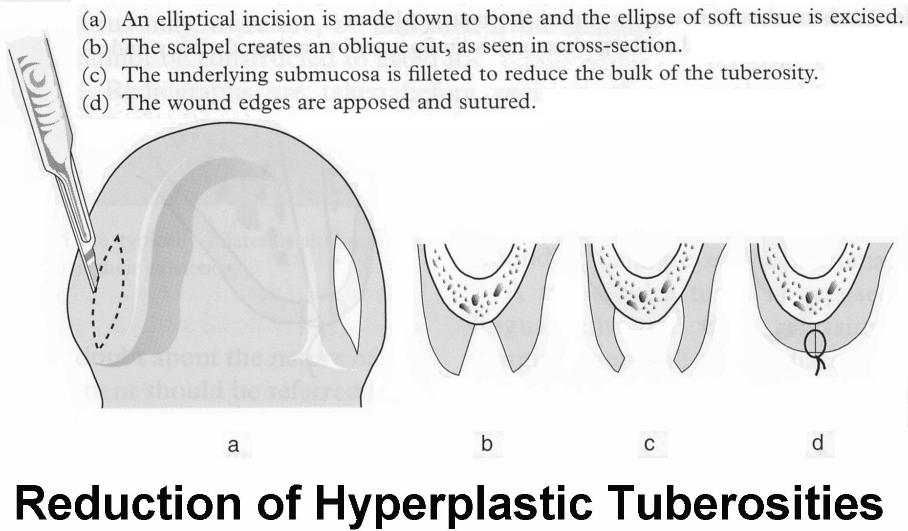 Reduction of Hyperplastic Tuberosities7