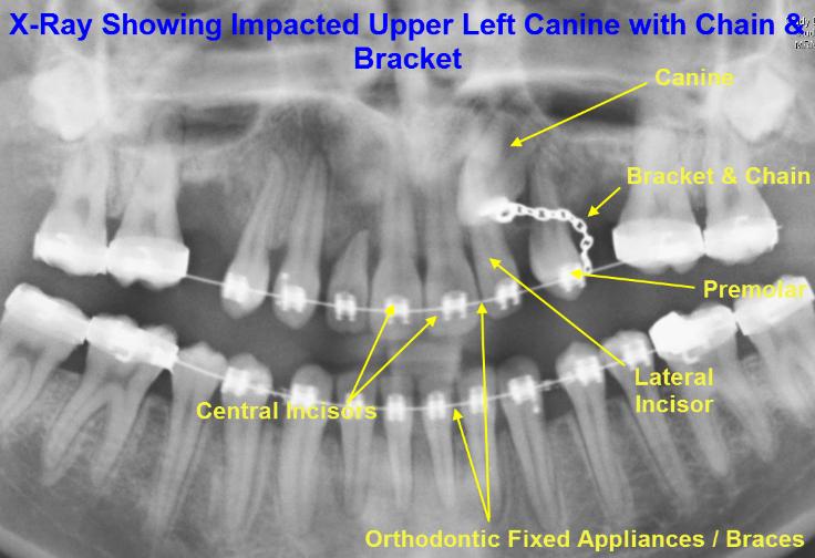 Exposing & Bonding of Brackets to Teeth Explanation & Warnings12