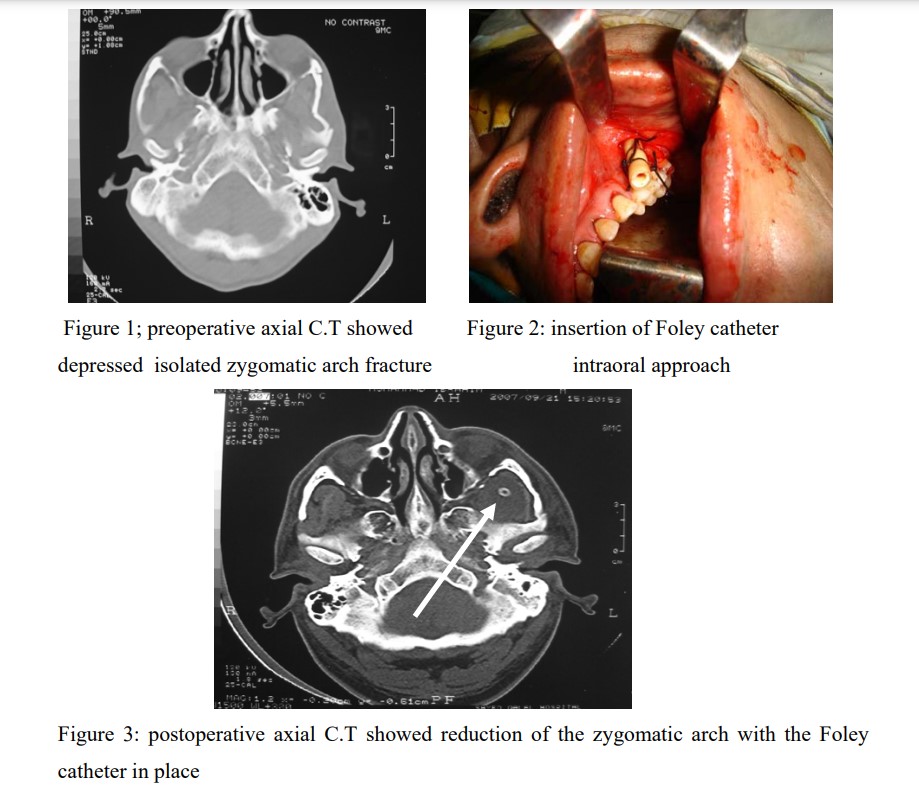 Foley Catheter Stabilization of Isolated Zygomatic Arch Fracture- An Intra Oral Approach3
