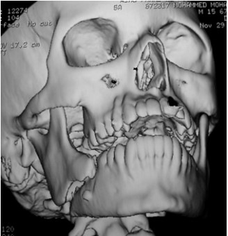 Relationship between Fractures of Mandibular Angle and the Presence of a Lower Third Molar12