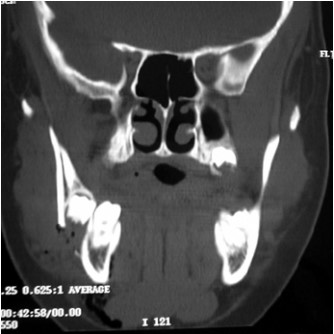 Relationship between Fractures of Mandibular Angle and the Presence of a Lower Third Molar13