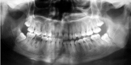 Relationship between Fractures of Mandibular Angle and the Presence of a Lower Third Molar14