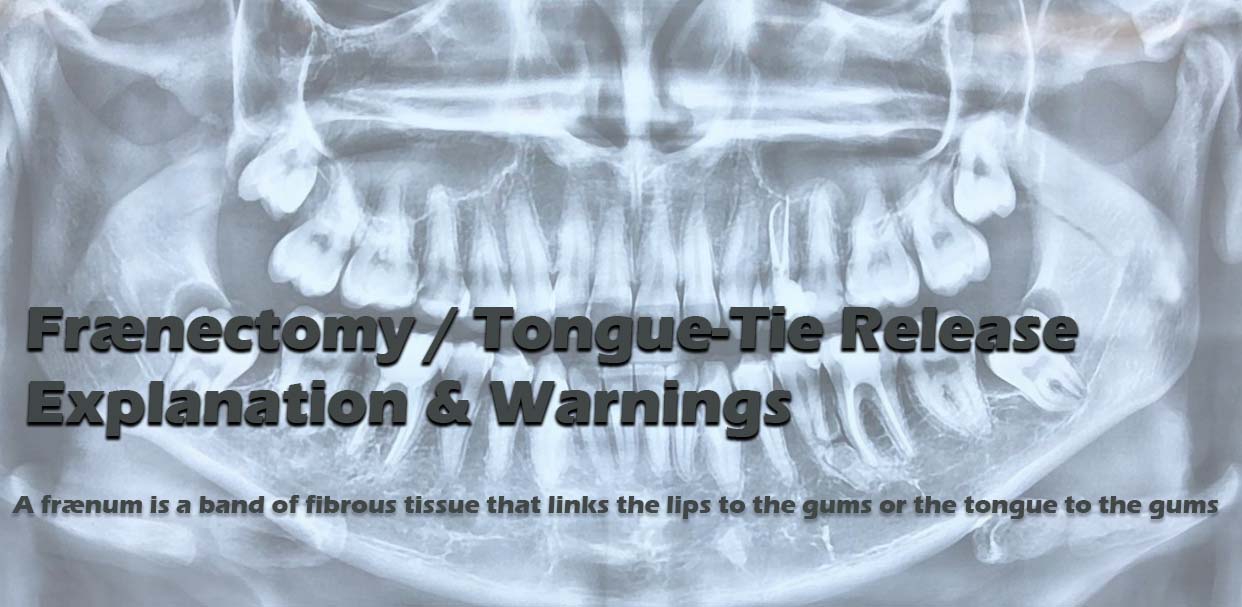 Fraenectomy / Tongue-Tie Release Explanation & Warnings