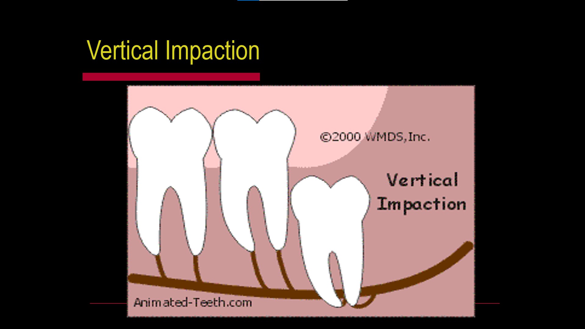 Impacted teeth2