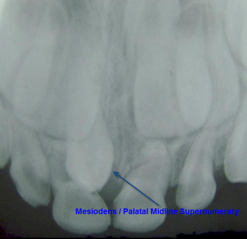 Ectopic & Supernumerary Tooth Removal Warnings5