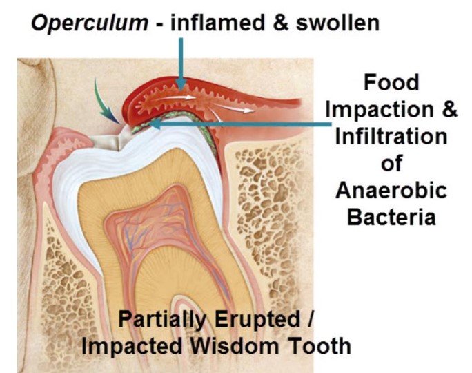 Pericoronitis7