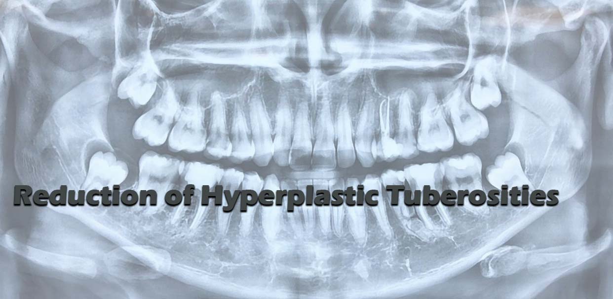 Reduction of Hyperplastic Tuberosities