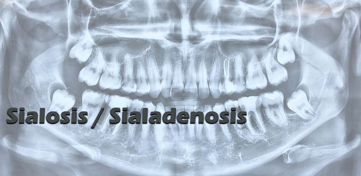 Sialosis / Sialadenosis