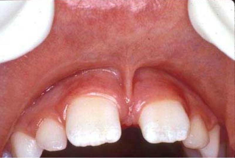Fraenectomy / Tongue-Tie Release Explanation & Warnings4