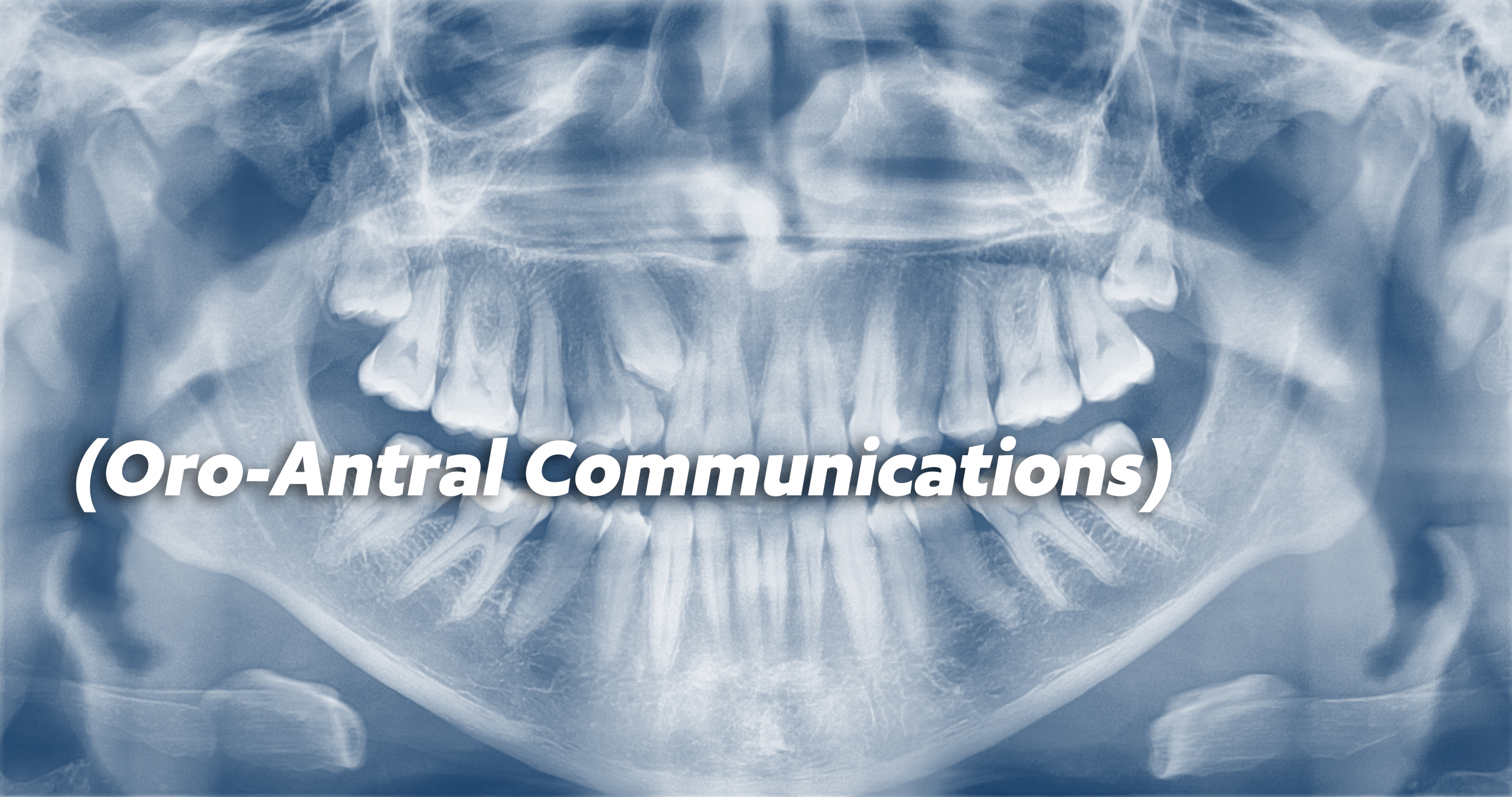 Oro-Antral Communications